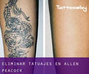 Eliminar tatuajes en Allen Peacock
