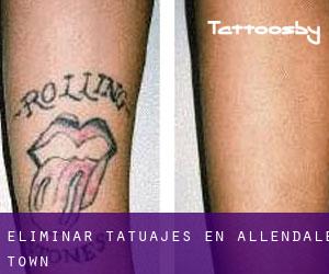 Eliminar tatuajes en Allendale Town