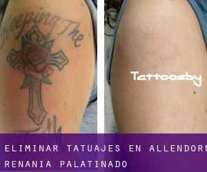 Eliminar tatuajes en Allendorf (Renania-Palatinado)