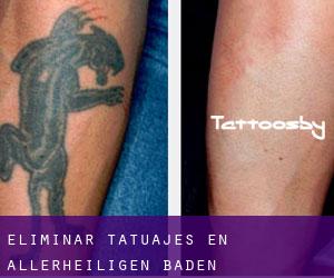 Eliminar tatuajes en Allerheiligen (Baden-Württemberg)