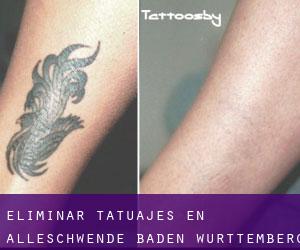 Eliminar tatuajes en Alleschwende (Baden-Württemberg)