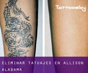 Eliminar tatuajes en Allison (Alabama)