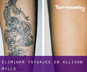 Eliminar tatuajes en Allison Mills
