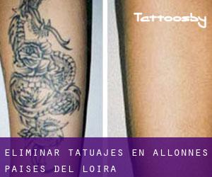 Eliminar tatuajes en Allonnes (Países del Loira)