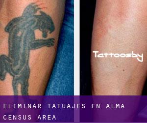 Eliminar tatuajes en Alma (census area)
