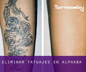 Eliminar tatuajes en Alphaba