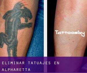 Eliminar tatuajes en Alpharetta