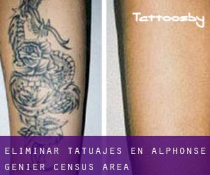 Eliminar tatuajes en Alphonse-Génier (census area)