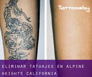Eliminar tatuajes en Alpine Heights (California)