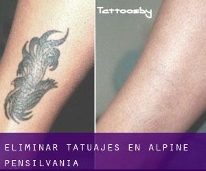 Eliminar tatuajes en Alpine (Pensilvania)