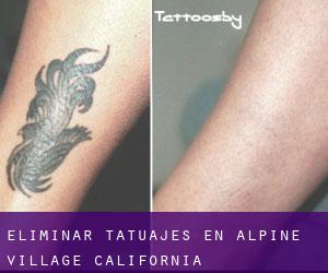 Eliminar tatuajes en Alpine Village (California)