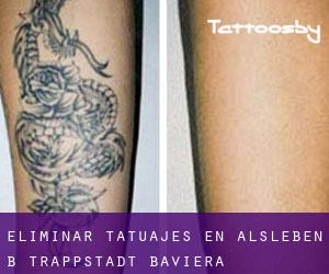 Eliminar tatuajes en Alsleben b. Trappstadt (Baviera)