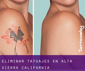 Eliminar tatuajes en Alta Sierra (California)