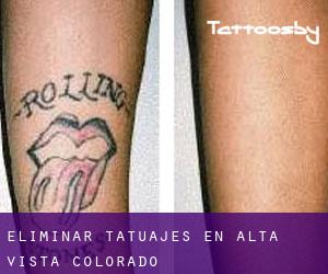 Eliminar tatuajes en Alta Vista (Colorado)