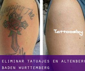 Eliminar tatuajes en Altenberg (Baden-Württemberg)