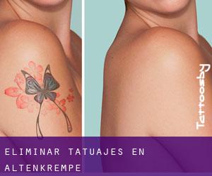 Eliminar tatuajes en Altenkrempe