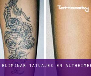 Eliminar tatuajes en Altheimer
