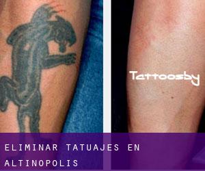 Eliminar tatuajes en Altinópolis