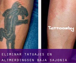 Eliminar tatuajes en Altmerdingsen (Baja Sajonia)