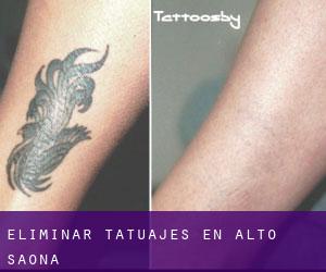 Eliminar tatuajes en Alto Saona