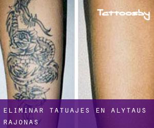 Eliminar tatuajes en Alytaus Rajonas