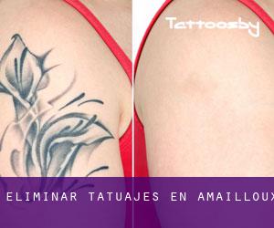 Eliminar tatuajes en Amailloux