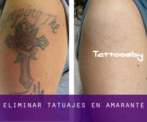 Eliminar tatuajes en Amarante