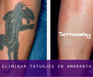 Eliminar tatuajes en Amaranth
