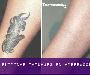 Eliminar tatuajes en Amberwood II
