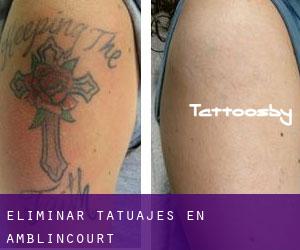 Eliminar tatuajes en Amblincourt