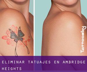Eliminar tatuajes en Ambridge Heights