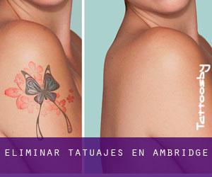 Eliminar tatuajes en Ambridge