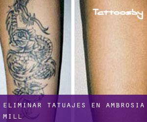 Eliminar tatuajes en Ambrosia Mill