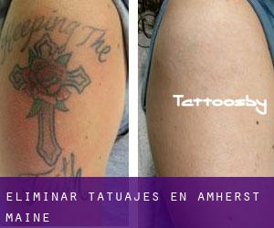 Eliminar tatuajes en Amherst (Maine)
