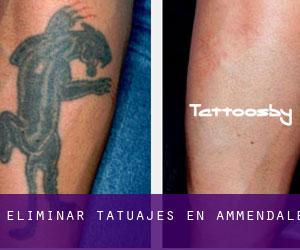 Eliminar tatuajes en Ammendale