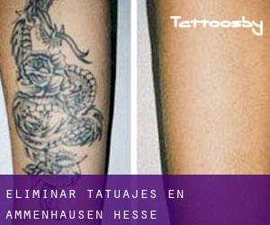 Eliminar tatuajes en Ammenhausen (Hesse)