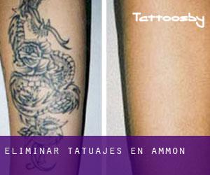 Eliminar tatuajes en Ammon