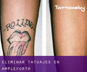 Eliminar tatuajes en Ampleforth