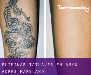 Eliminar tatuajes en Amys Acres (Maryland)