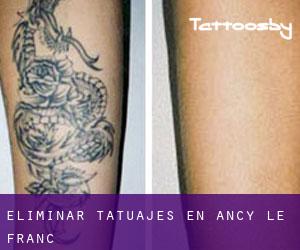 Eliminar tatuajes en Ancy-le-Franc