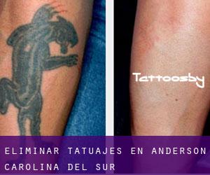 Eliminar tatuajes en Anderson (Carolina del Sur)