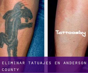 Eliminar tatuajes en Anderson County