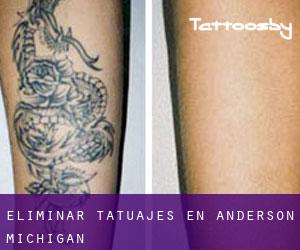 Eliminar tatuajes en Anderson (Michigan)