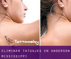 Eliminar tatuajes en Anderson (Mississippi)