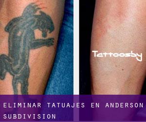 Eliminar tatuajes en Anderson Subdivision