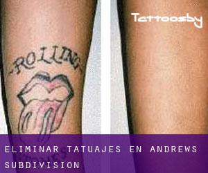 Eliminar tatuajes en Andrews Subdivision