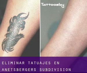Eliminar tatuajes en Anetsberger's Subdivision