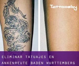 Eliminar tatuajes en Ankenreute (Baden-Württemberg)