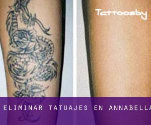 Eliminar tatuajes en Annabella