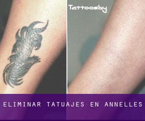 Eliminar tatuajes en Annelles